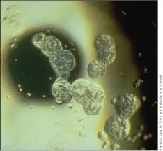 This is an example of a contact lens coated with lipid deposits. Do you really want to keep putting something that look like that in your eye?
