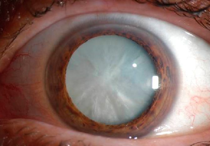 This is an example of an extremely dense cataract. They almost never get this bad in Canada as people usually seek treatment before their vision is this bad.