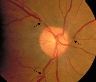 In this picture you can see the silvering of some blood vessels and also see how some blood vessels are 'nicking' or pinching the ones underneath. This is typically what I see in the average person with uncontrolled, untreated high blood pressure.