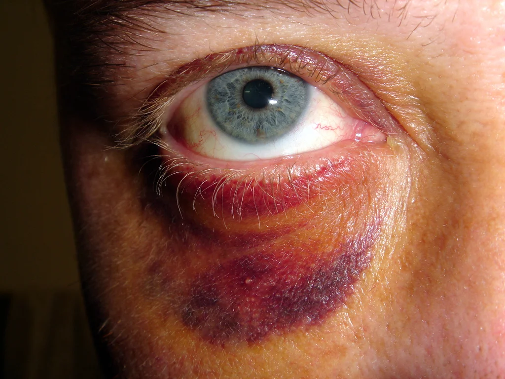 I should see an eye doctor for that? - Eye injuries