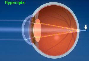 Light focuses behind the retina in hyperopia