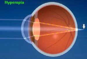 Hyperopia - A frustrating lack of focus