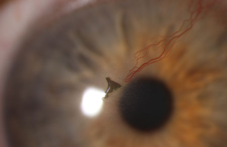 Ouch. If you get something in your eye don’t delay. Be seen by a doctor of optometry as soon as possible!
