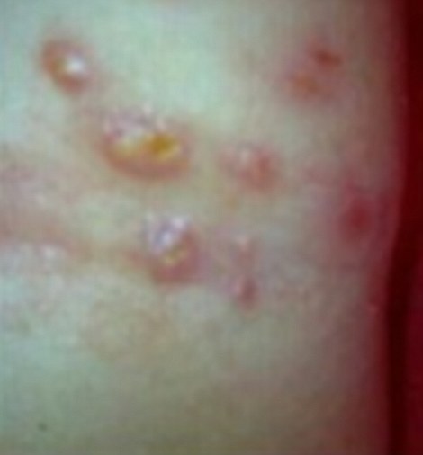 Eczema