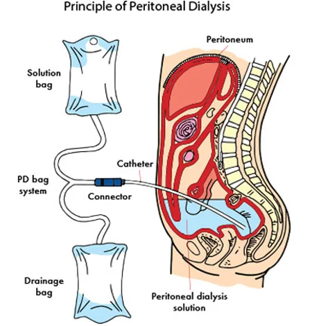 principle-of-peritoneal-dialysis.jpg