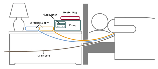 This is how the Cycler is set up while I sleep. The drain line goes to the toilet.