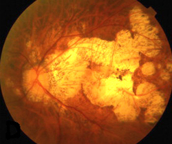 high myopia retina a látás nem esett