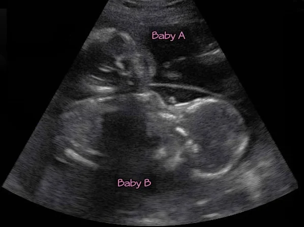 birthing-instincts-twin-ultrasound.jpg