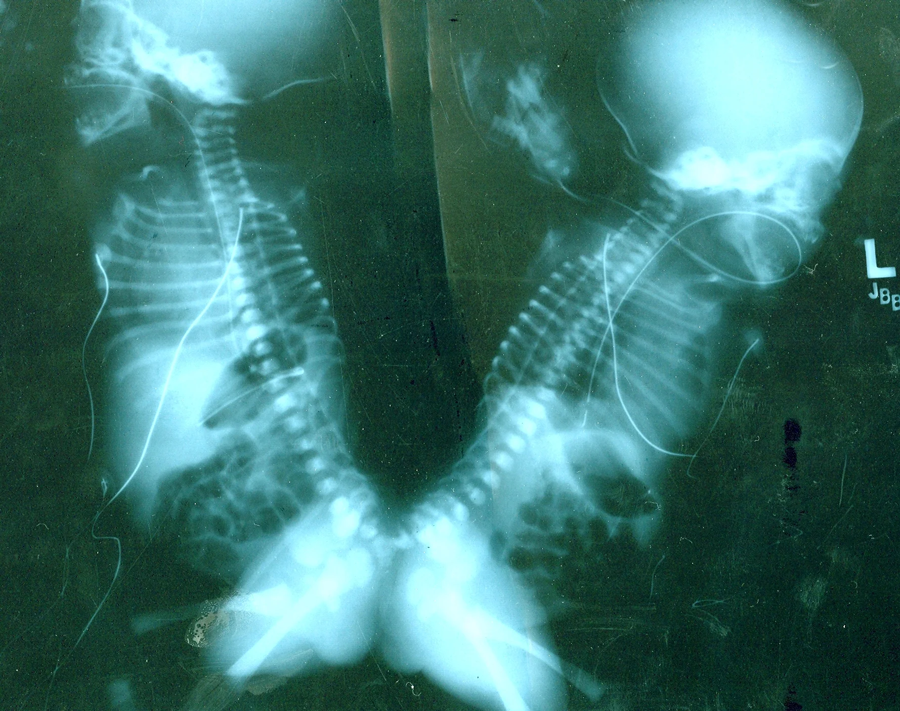 Happy Sisterectomy Day!