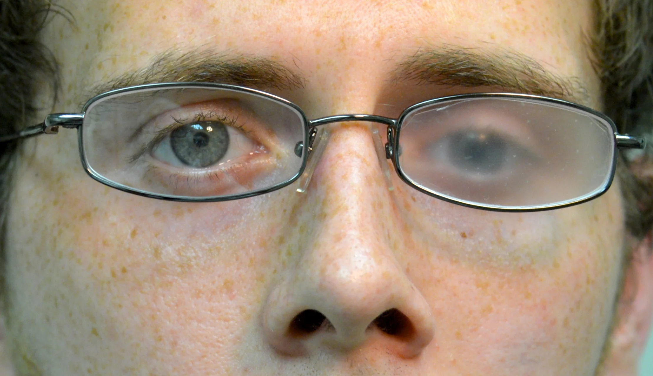 Understanding Double Vision — Vision After Brain Injury