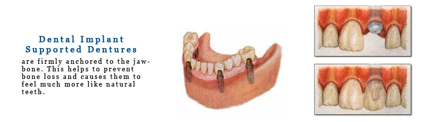 Dental_Impants_Pic_NoFrame.jpg