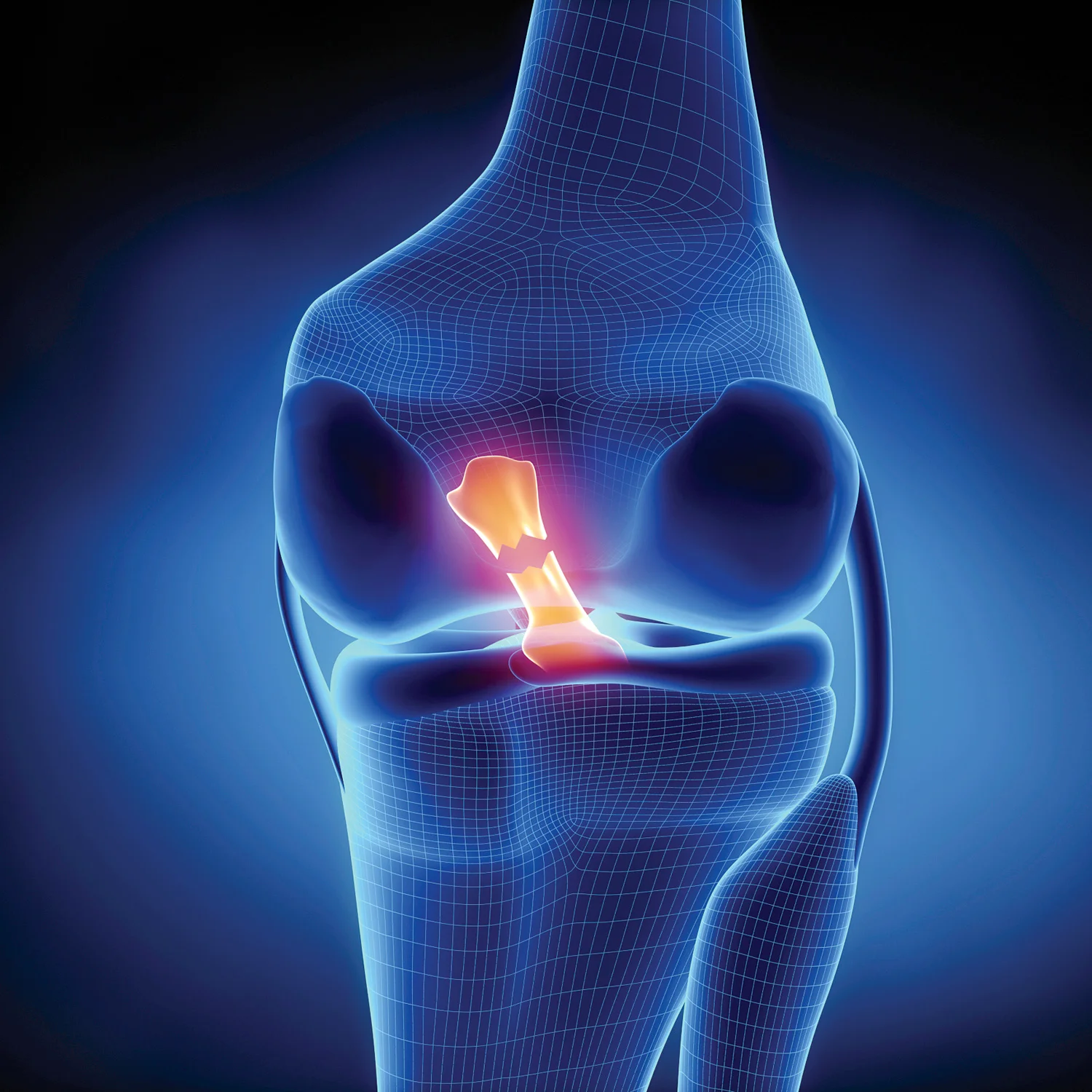 ACL Rehab Protocol 