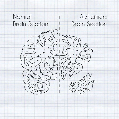 A healthy brain compared with an Alzheimer's brain