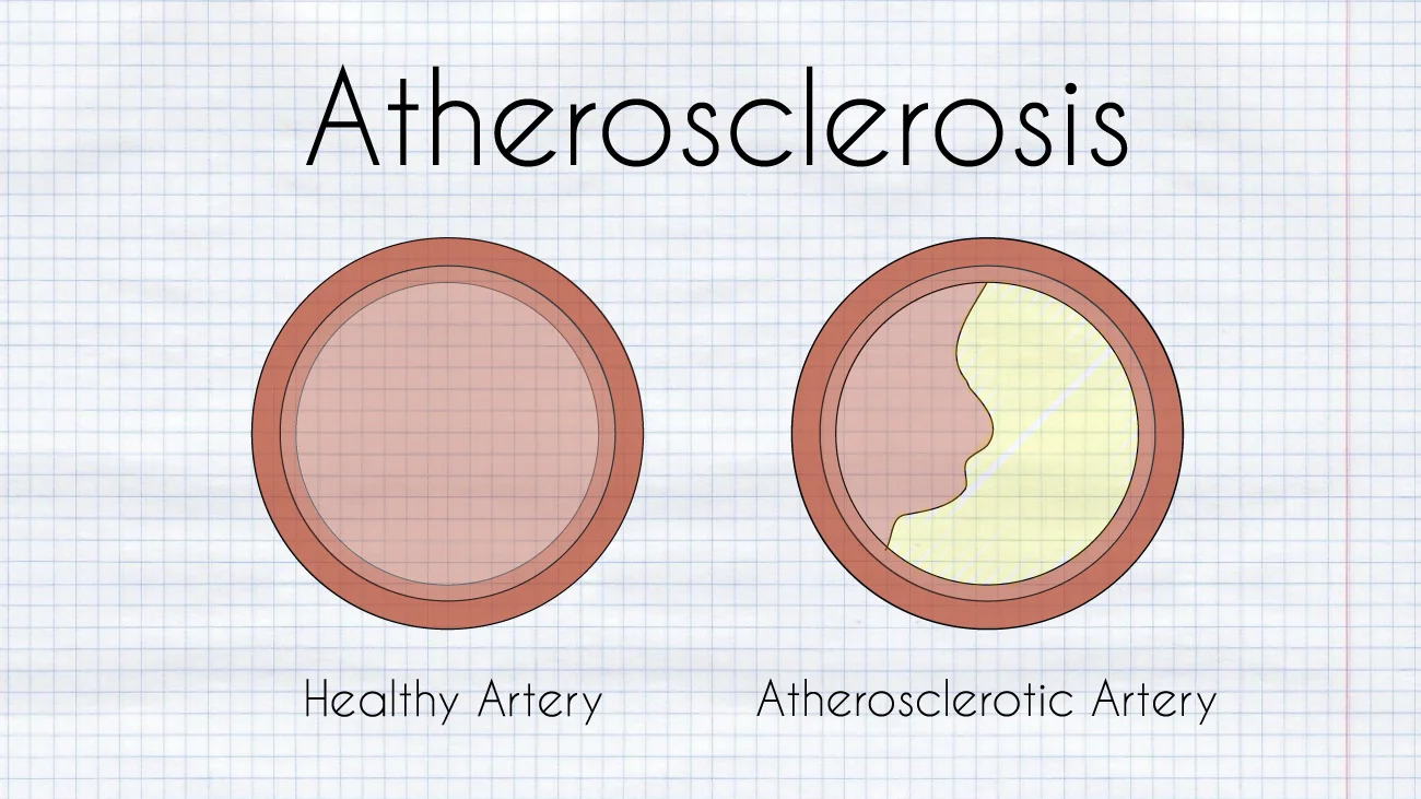 Diagram of atherosclerosis narrowing an artery