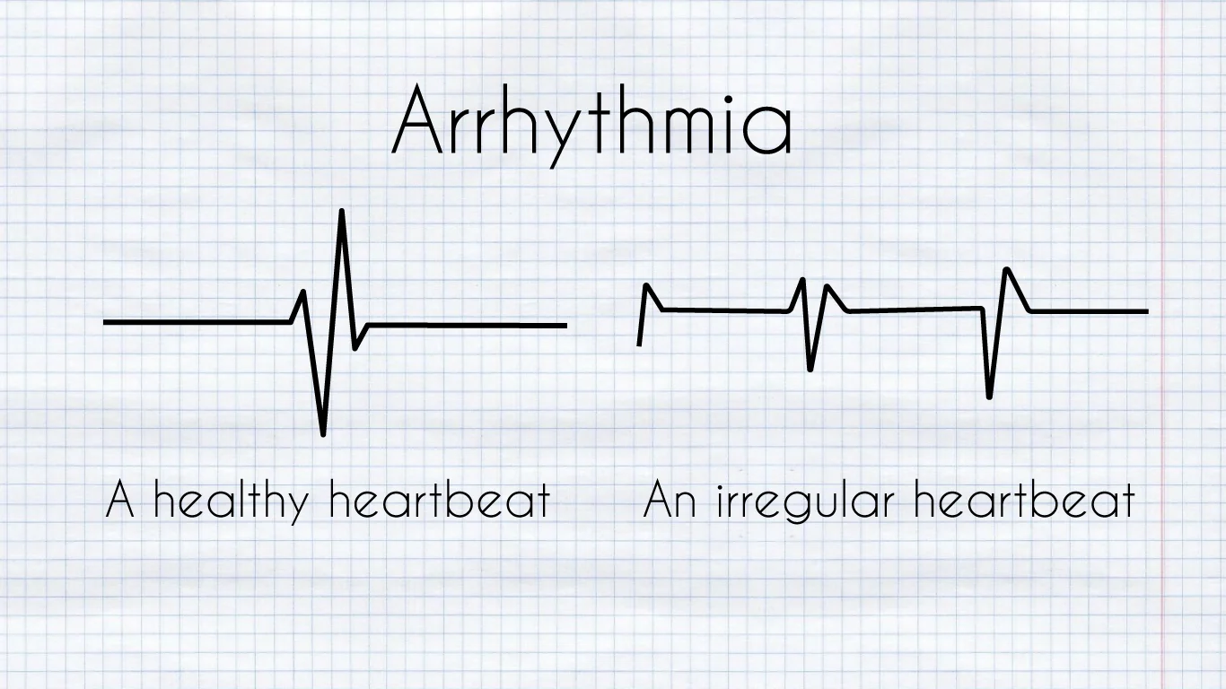 Diagram of heart arrhythmia
