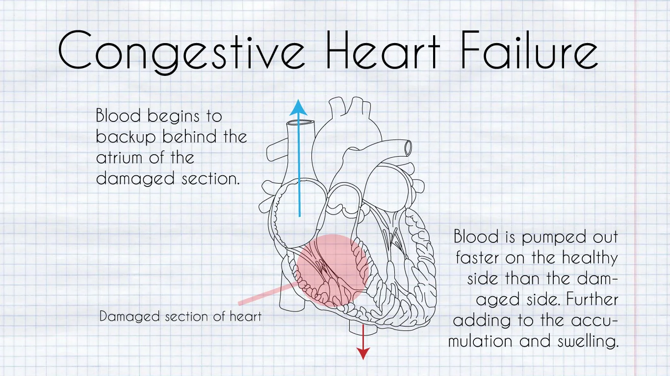 Diagram of congestive heart failure