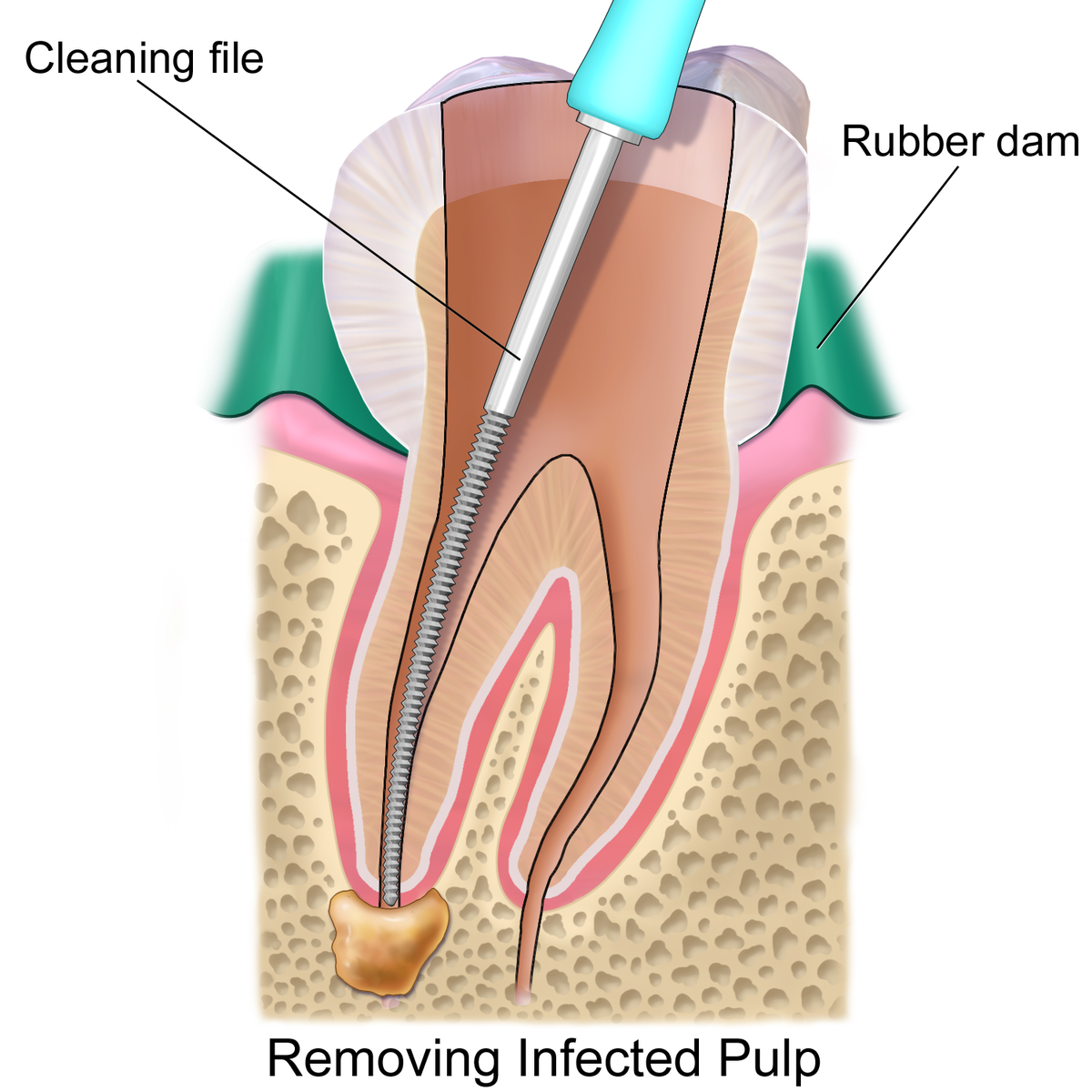 root-canal-treatment.png