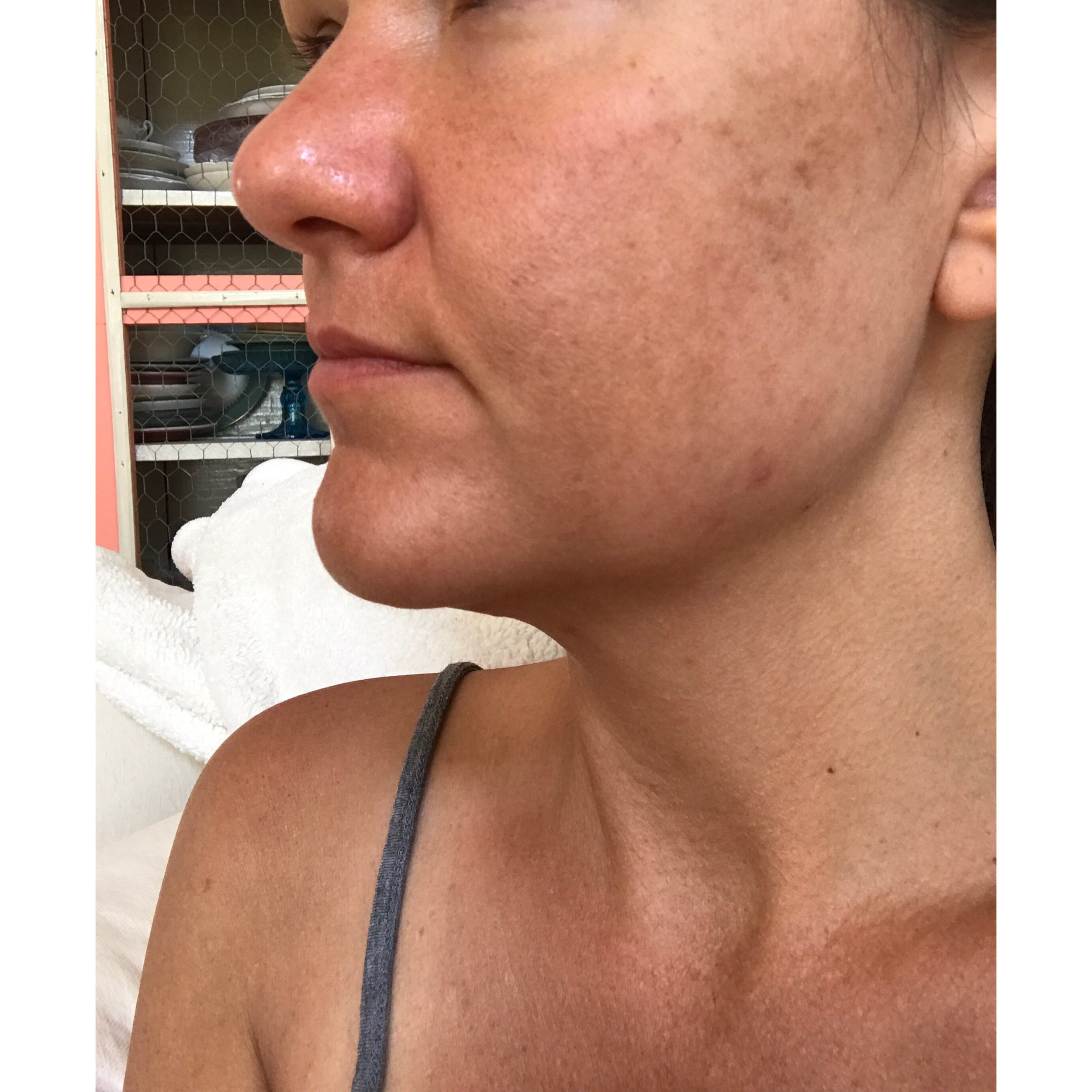 retinol rosacea reddit