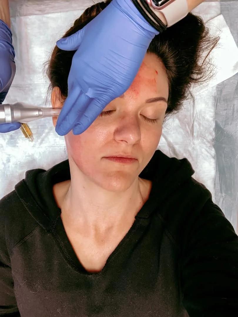 How I Fixed My Horrible Skin After 20 Years Of Tanning + Acne