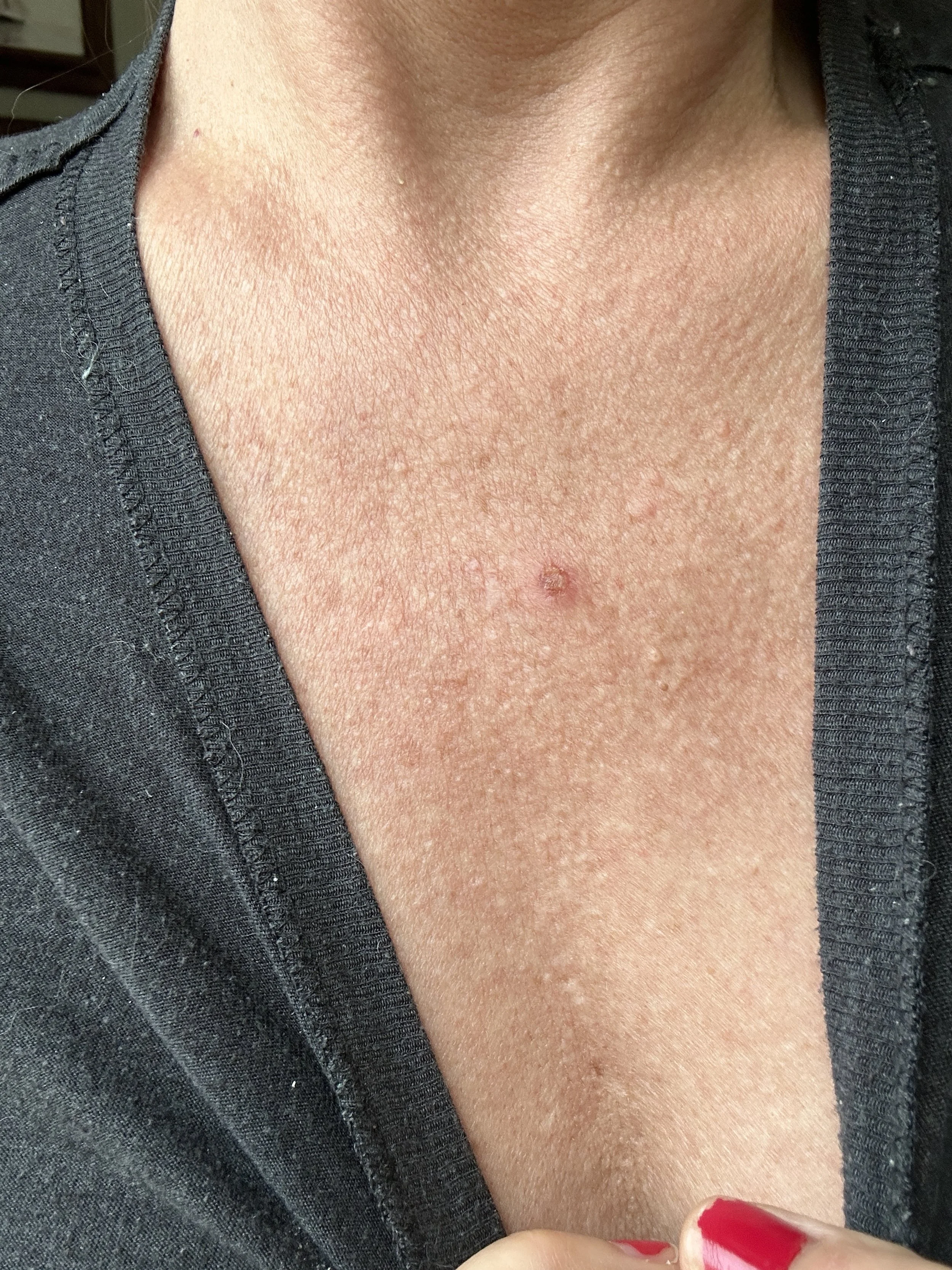 Skin Cancer Has Impeccable Timing