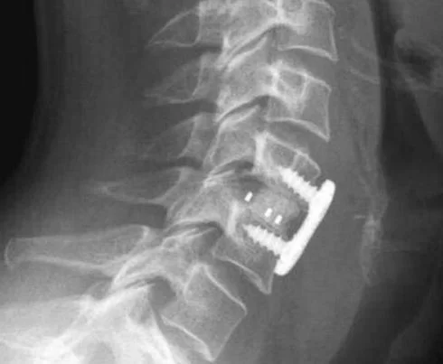 Neck Surgery.jpg
