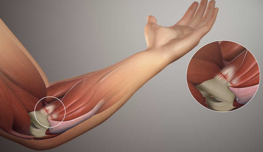 Golfer s Elbow Chiropractic Saint Louis Chiropractors In Webster Groves MO