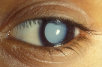 Fig. 1 A cloudy lens prevents light from reaching the back of the eye.