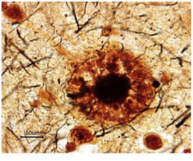 A Pathway Towards Alzheimer’s Disease Treatments: Understanding the Role of ApoE in Human Neuron Physiology