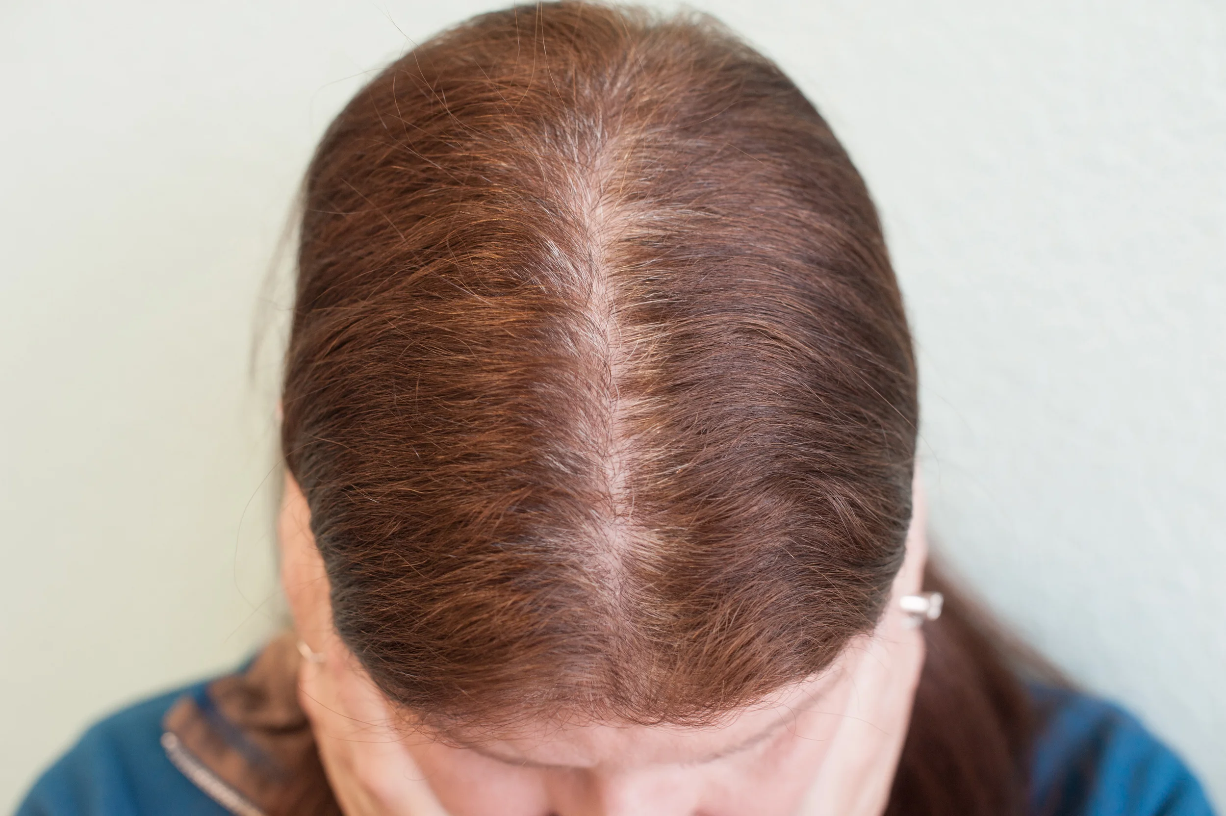 You can still see the gray but it's not as severe. It looks like I have thinning hair, but it's just white! 