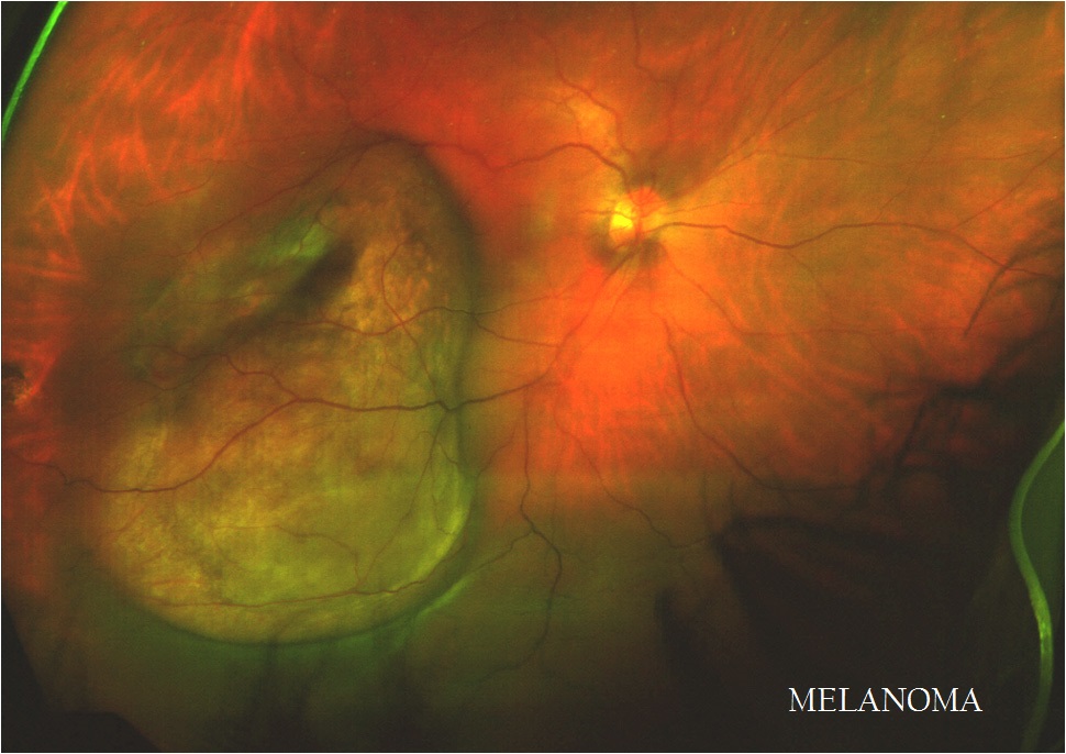Melanoma1.jpg