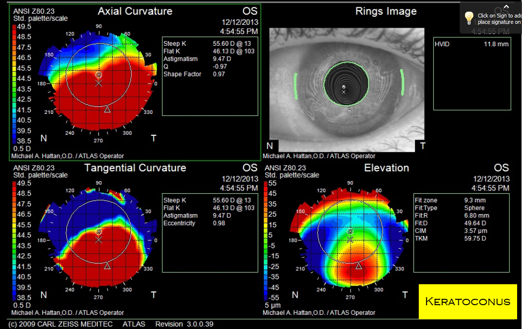 Keratoconus.jpg