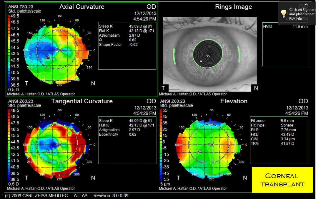CornealTransplant.jpg
