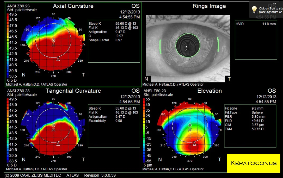 Keratoconus.jpg