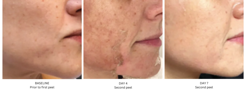 BASELINE-Prior-to-first-peel-1024x384.png