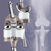 Revision Knee Components
