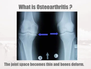 What is Osteoarthritis ? 