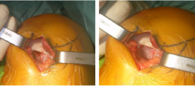 Before & After MACI Implantation