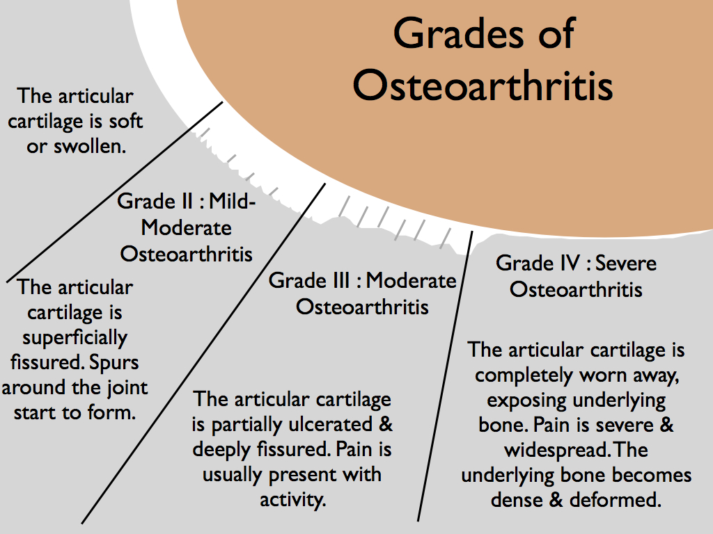 Grade of Osteoathritis.jpg