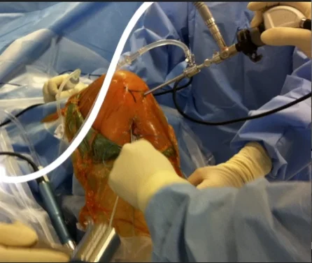 Knee Arthroscopy.jpg