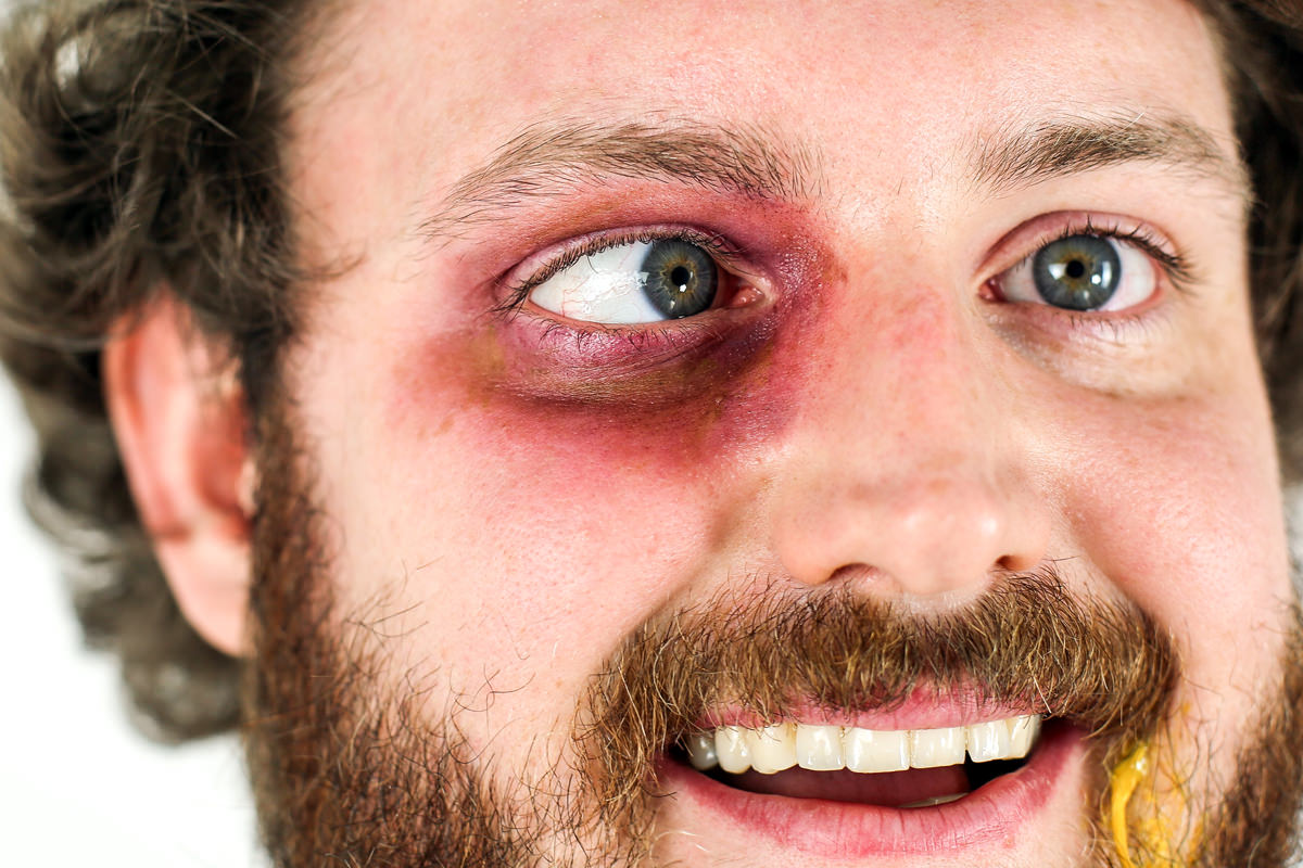 head-black_eye.jpg