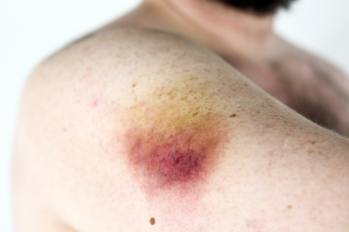 arms-bruise.jpg