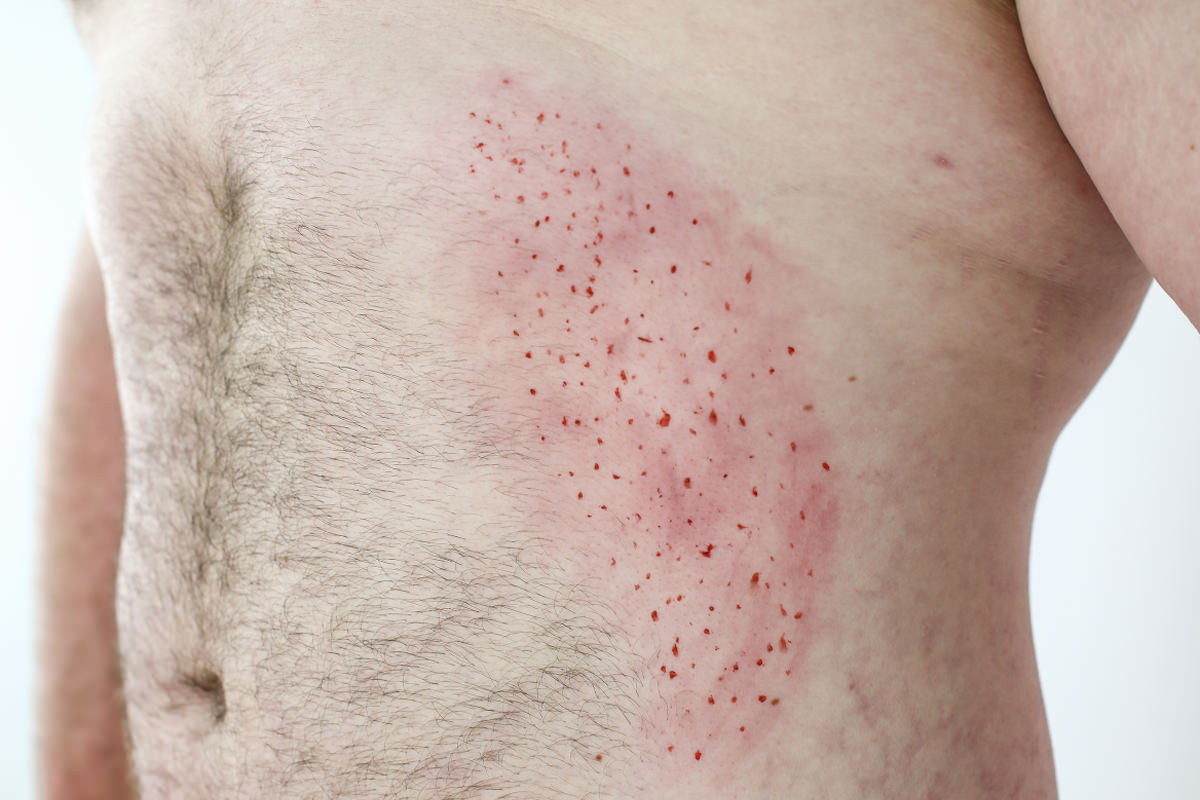 stomach-rash.jpg