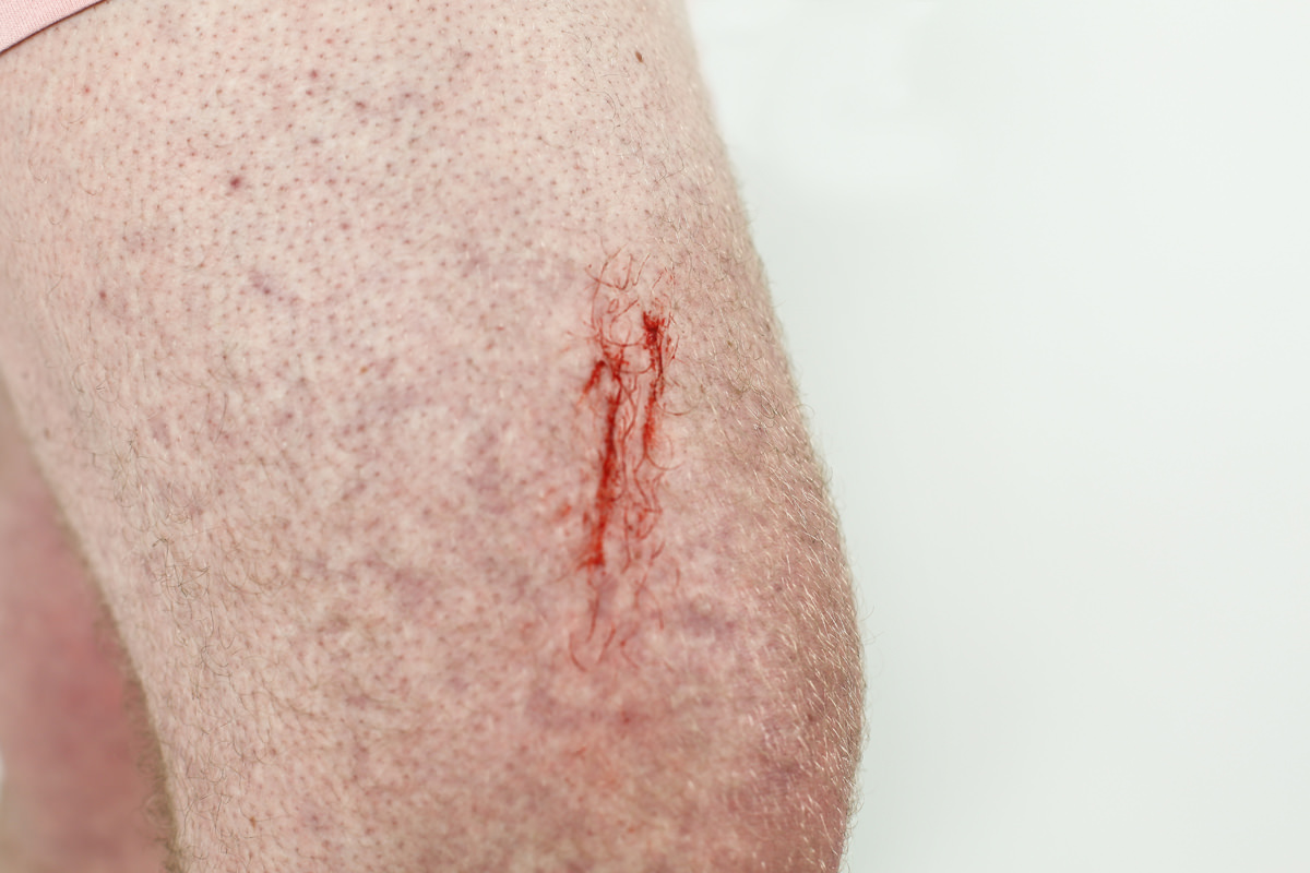 legs-cat_scratch.jpg