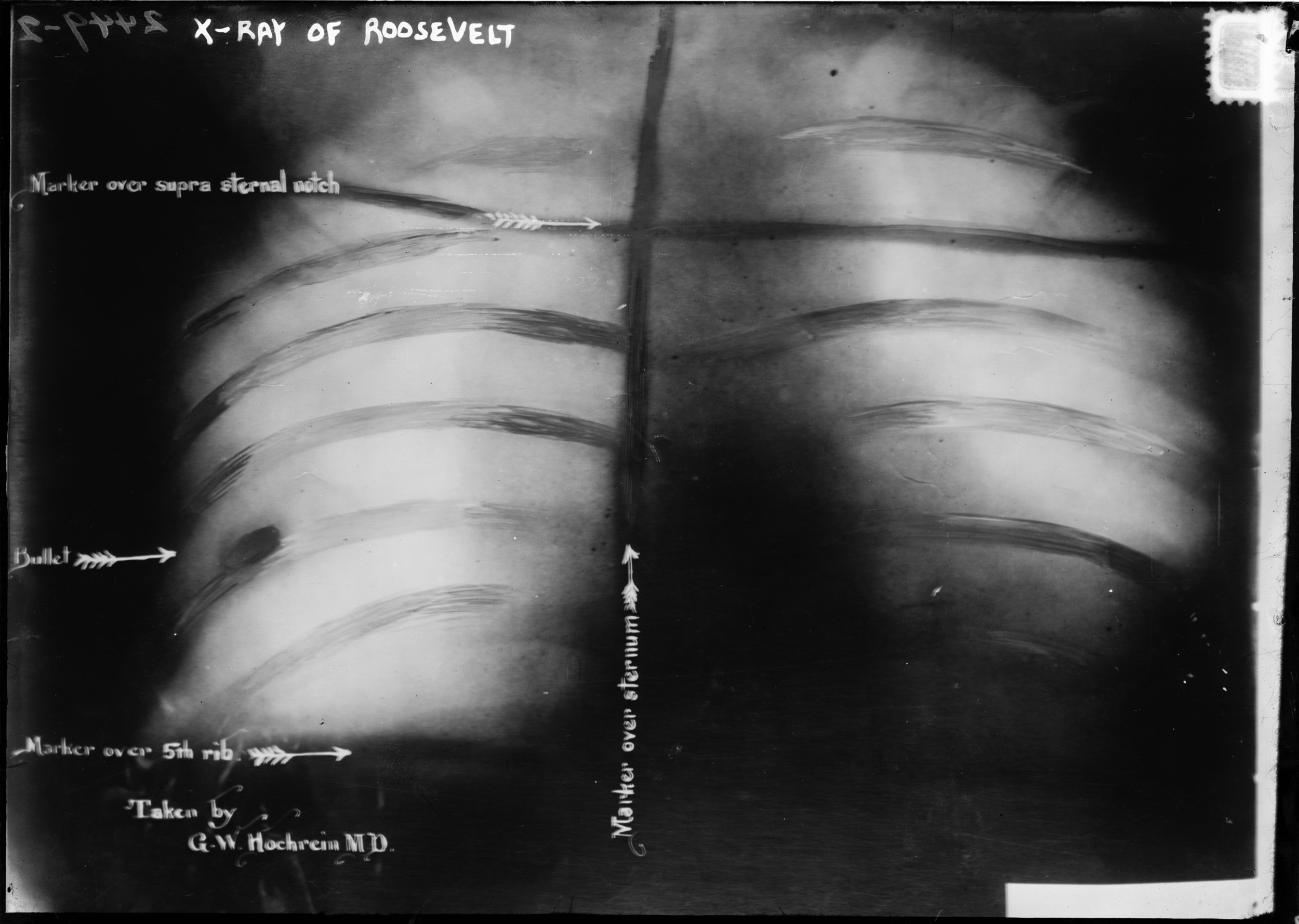 X-ray of Roosevelt's ribs with embedded bullet