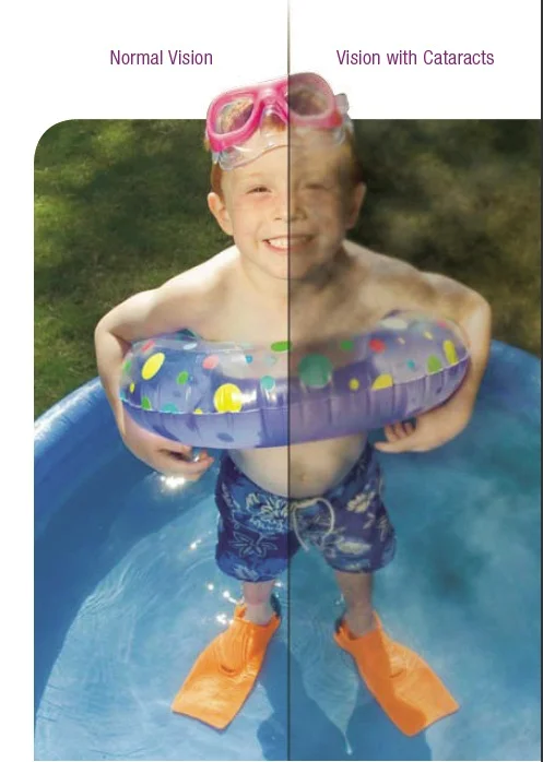 cataracts example.jpg