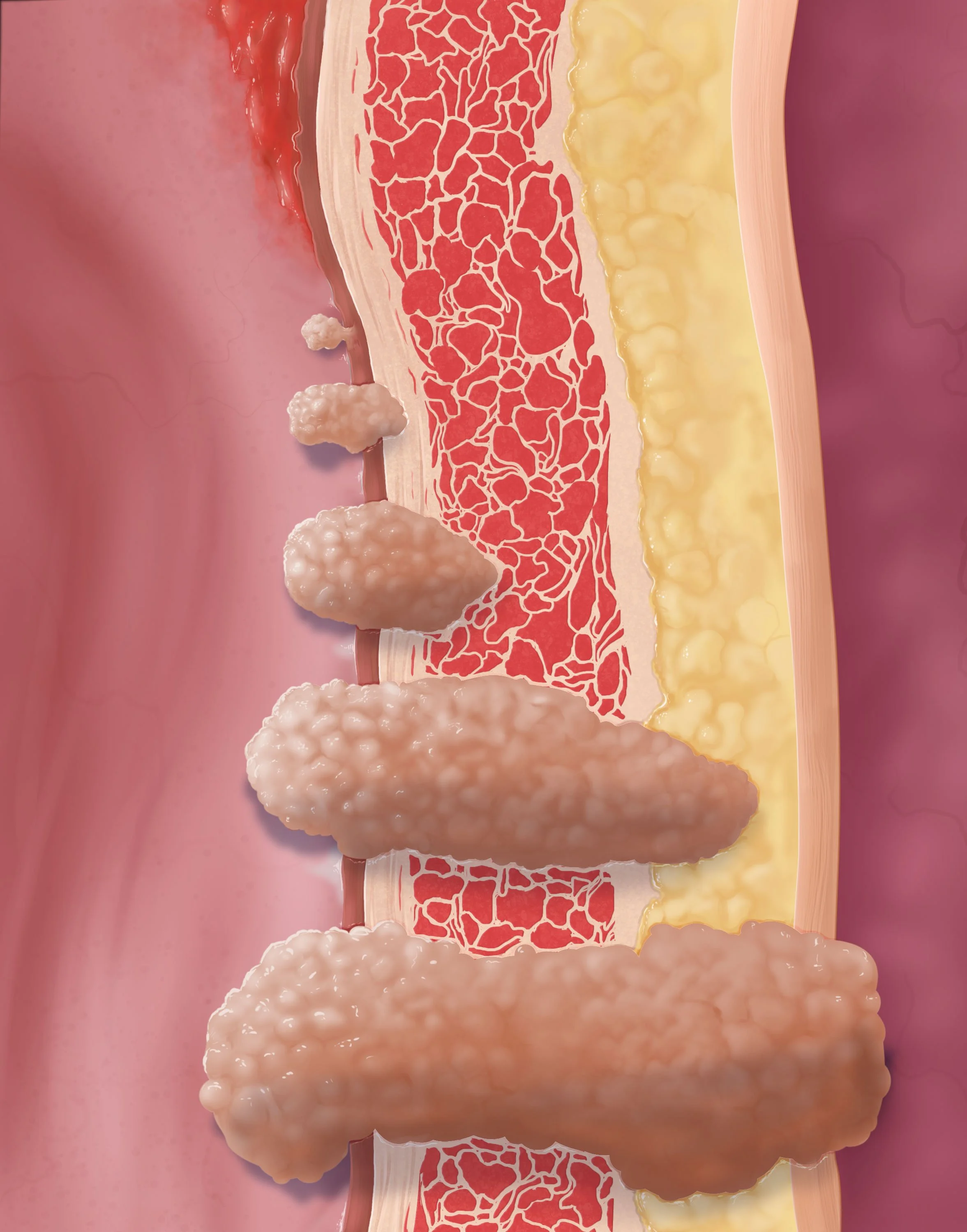 Bladder_TNM-Staging_Layers.jpg