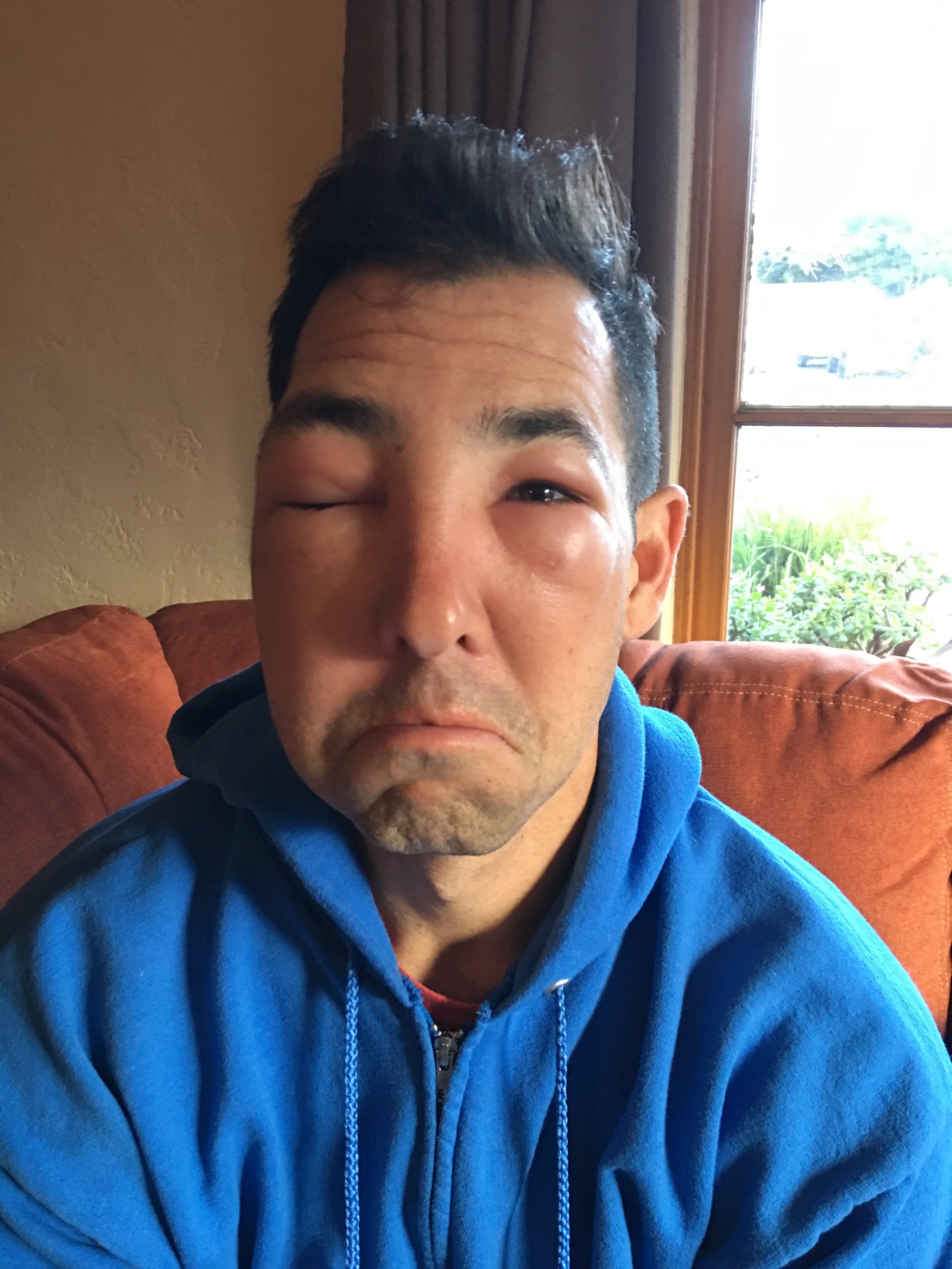 What happens when you are allergic to a bee sting, and you get stung. Hope you feel better soon Rob. 