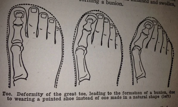 Even doctors 70 years ago knew that small toe boxes hurt the feet-yet we still have so many uncomfortable shoe options! This is from my 1940's book "The New Modern Home Physician."