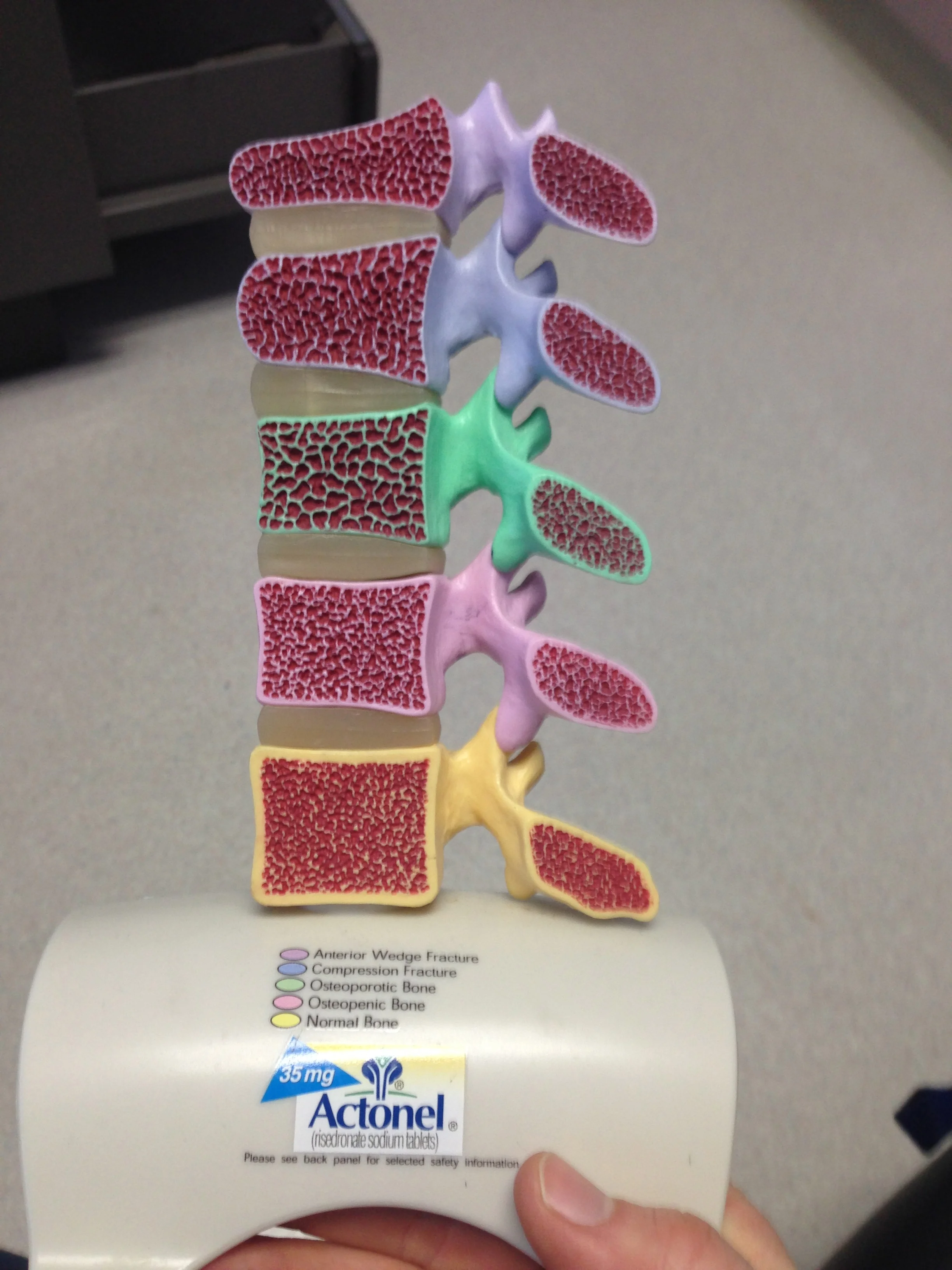 When I was at my doctor's office, I took a few pictures of this model spine, which shows a range of spinal issues. Focus on the bottom three, (green, pink, and yellow), which compares bone density for osteoporosis (green), osteopenia (pink), and normal (yellow) bones. Notice how large the porous surfaces are with the osteoporosis?