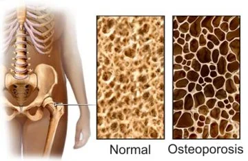 Image from: www.physioworks.com.au/